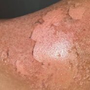 مقابله با بیماری های پوستی در شرایط بقا